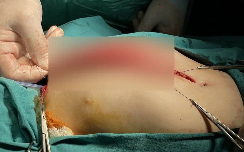 Körpənin qida borusu əməliyyatla əvəzləndi -  Azərbaycanda İLK - FOTO