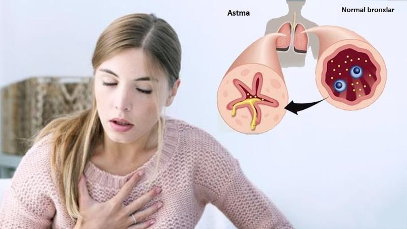 "Ata-anada bronxial astma varsa, uşaqda da ola bilər"   - Səhiyyə naziri mütəxəssisi