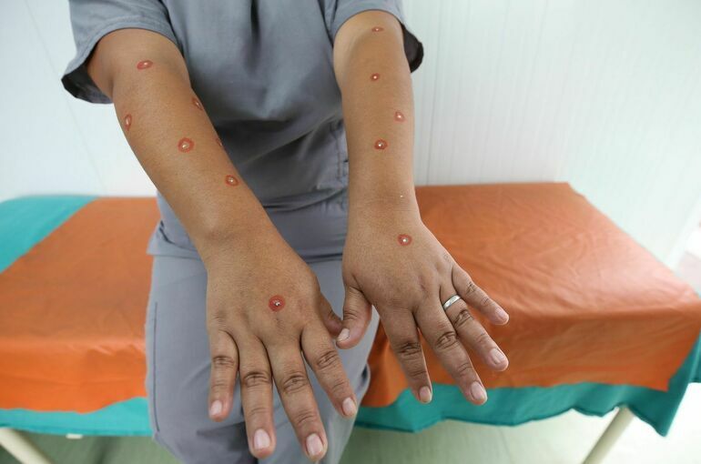 Meymunçiçəyinə yoluxan xəstə danışdı:    -  Bu Coviddən daha ağırdır