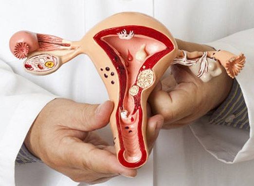 Endometrioz - uşaqlığın iltihabında faydalı    QIDALAR