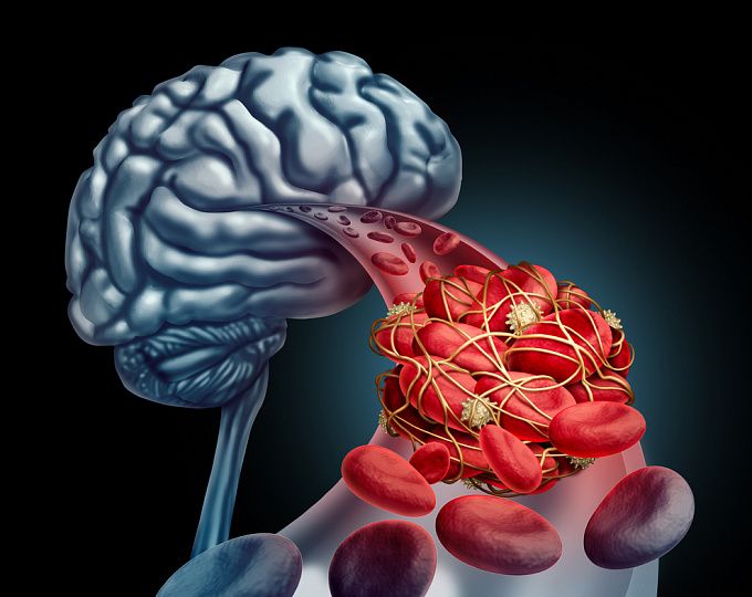 Beyin damarlarını şişirdib partladan    - Anevrizmanın əlamətləri 
