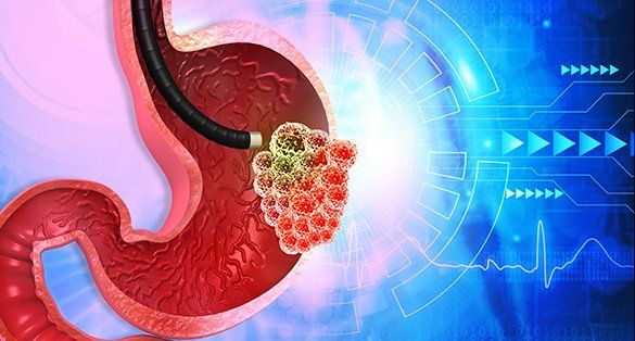 Bu vitamin əskikliyi mədə xərçəngini  - 5 dəfə artırır