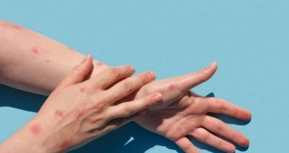 Dünyada 25 min insan meymunçiçəyinə yoluxub  -ÜST