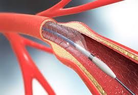 Hansı xəstələrin ürəyinə stent qoymaq olmaz? 