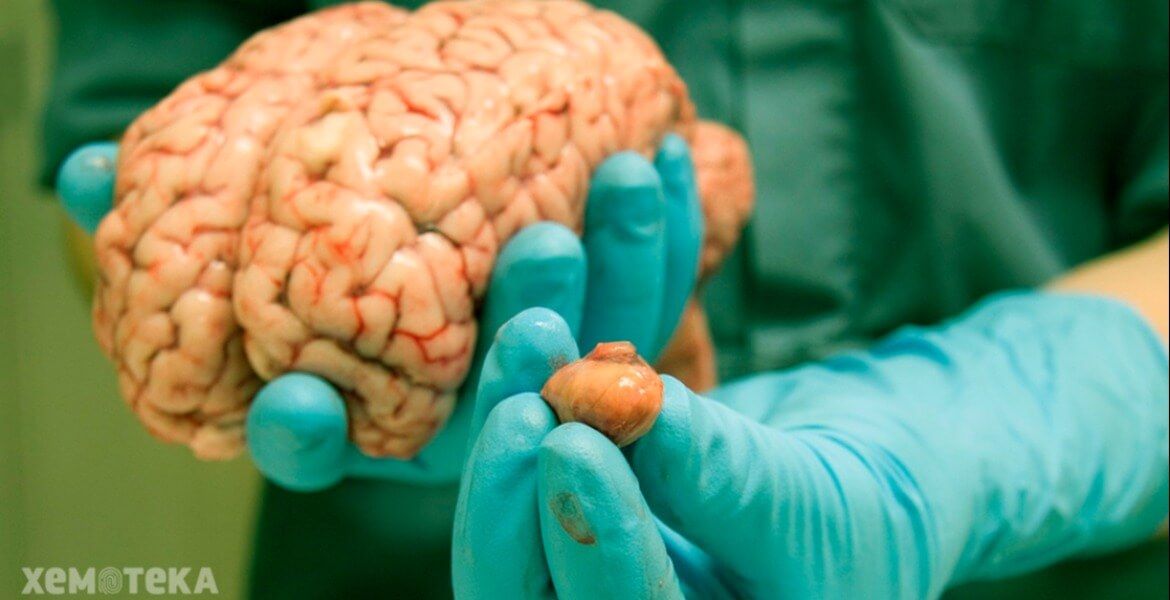  Beyin xərçəngi üçün ən xarakterik simptom  - AÇIQLANDI