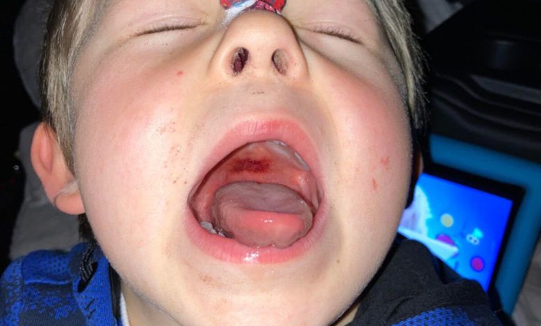 Uşaqlar arasında  "Strep A" infeksiyası yayılır 