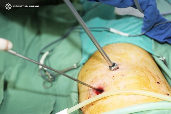 Klinik Tibbi mərkəzdə xəstənin ağciyərini örtən təbəqə   soyuldu 