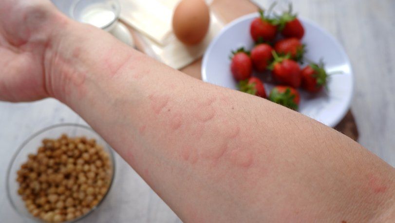 Böyüklərdə allergiya: dərman və qida allergiyasının    - ƏLAMƏTLƏRİ