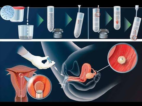 Süni mayalanma, nədir, necə aparılır?  -  Türkiyədə effektiv üsullar - VİDEO