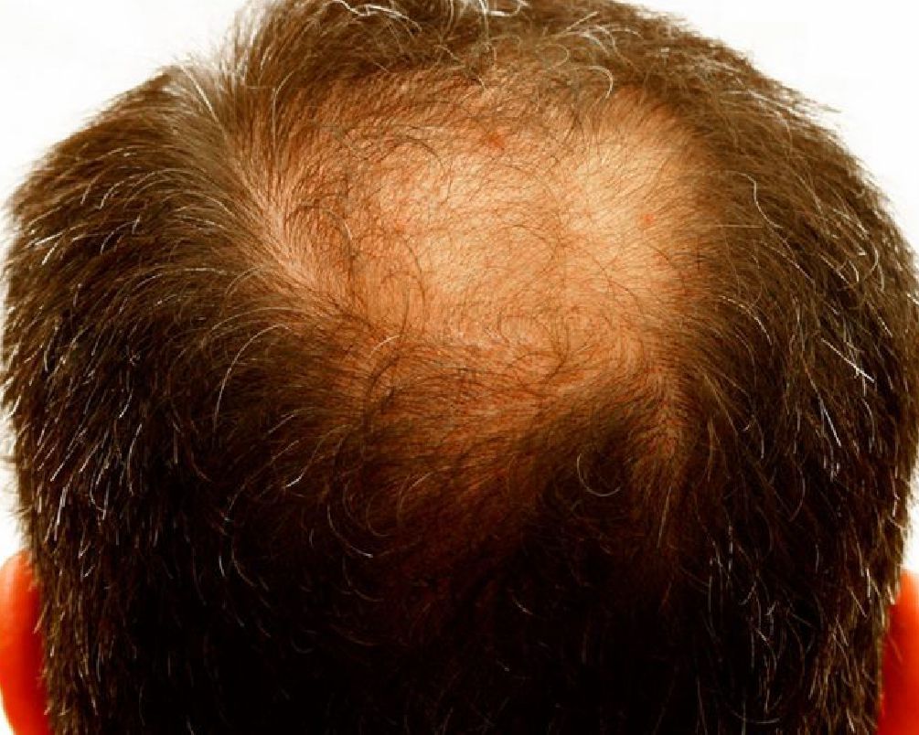 Kişilərdə saç tökülməsinin əsas səbəbləri 