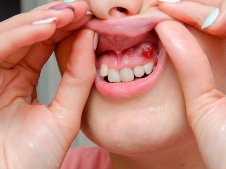 Diş kistləri niyə əmələ gəlir  – Xərçəngə səbəb olurmu?