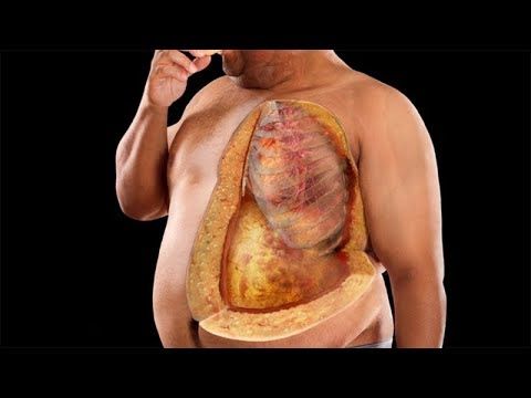 Artıq çəki və piy ürəyi genişləndirir  - Qəfil ölümün səbəbi