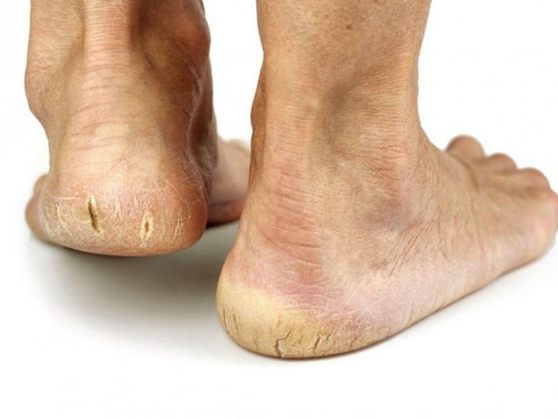 Dabanda çatları olanlar  – Bu vitaminləri qəbul etsin