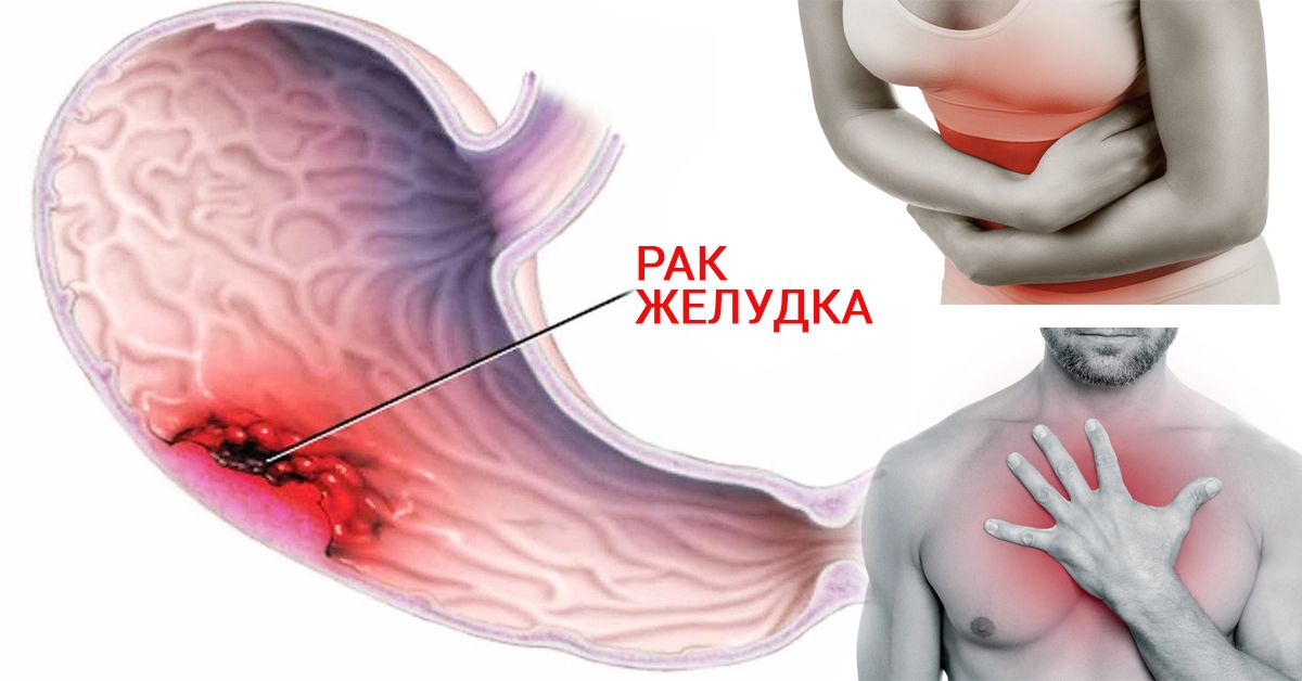 Kişilərdə qanazlığı onkoloji prosesdən  - xəbər verə bilər