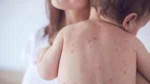 Qızılca yenə can aldı -  Virus Azərbaycandan nə vaxt “çıxacaq”?