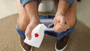 Babasil və bağırsaq xərçəngi zamanı   qanamanın fərqi