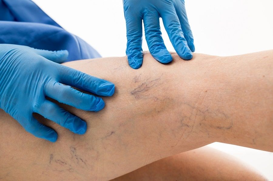 Varikozu olanları babasil və sonsuzluq gözləyə bilər  – Osteopat
