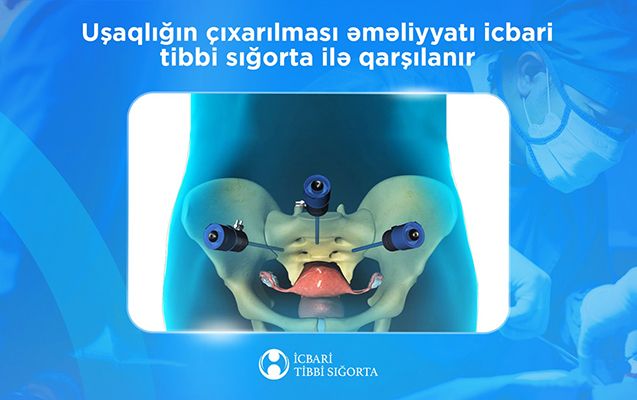 Daha bir əməliyyat  İcbari tibbi sığorta ilə qarşılanacaq