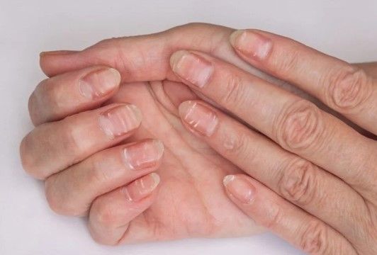 Dırnaqlarınızda ağ ləkələr varsa... –  Bu xəstəliklərin əlamətidir