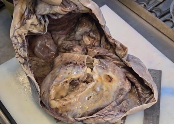 Bakıda qadının yumurtalığından çıxan  nəhəng kist şoka saldı – VİDEO