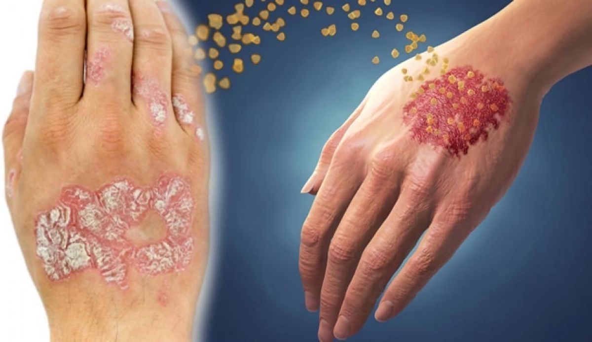 Sədəf, psoriaz, pullu dəmrov- - Ömürlük xəstəliyin səbəbləri