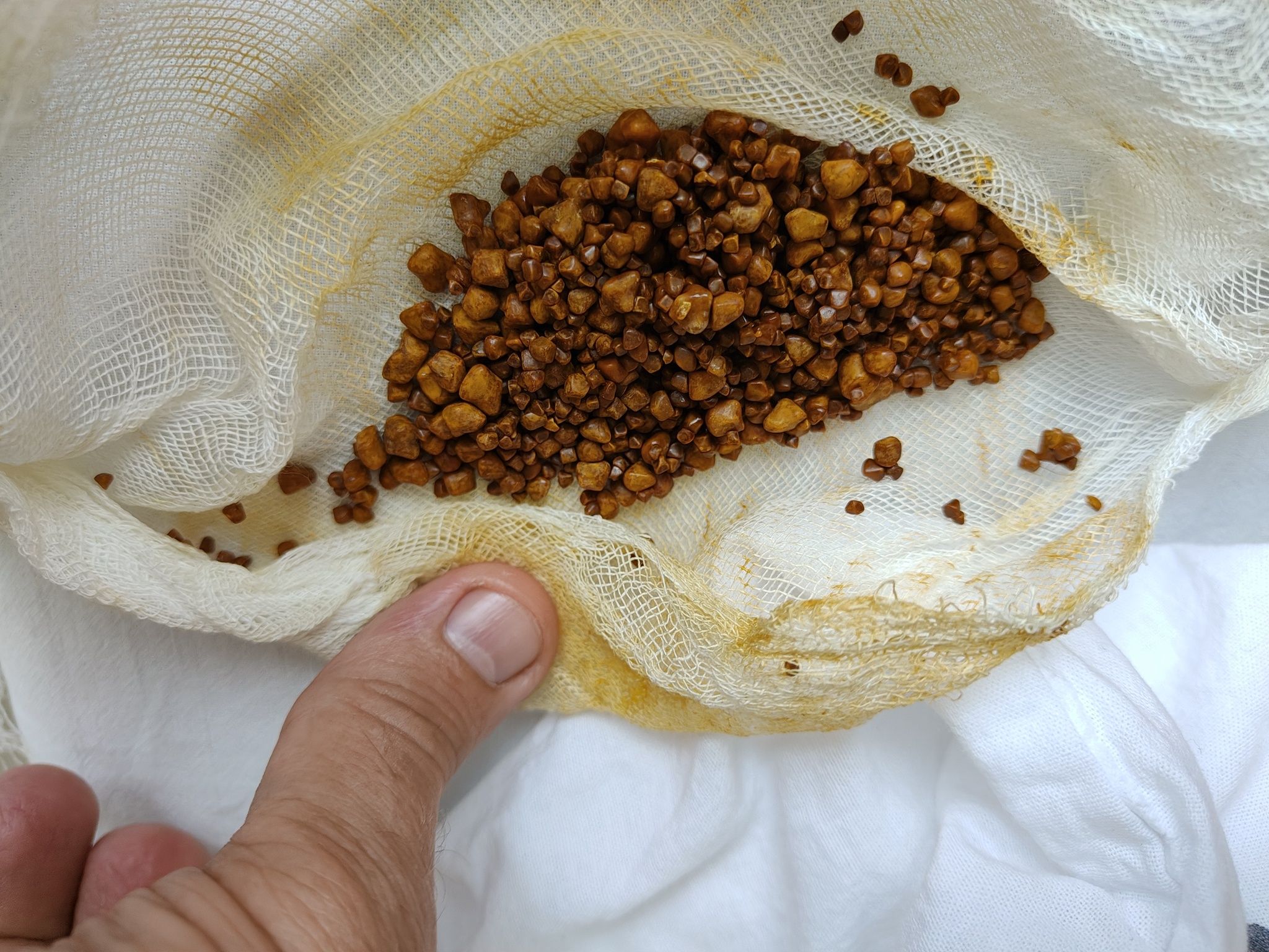 Kişinin öd kisəsindən 4000 daş çıxarıldı 