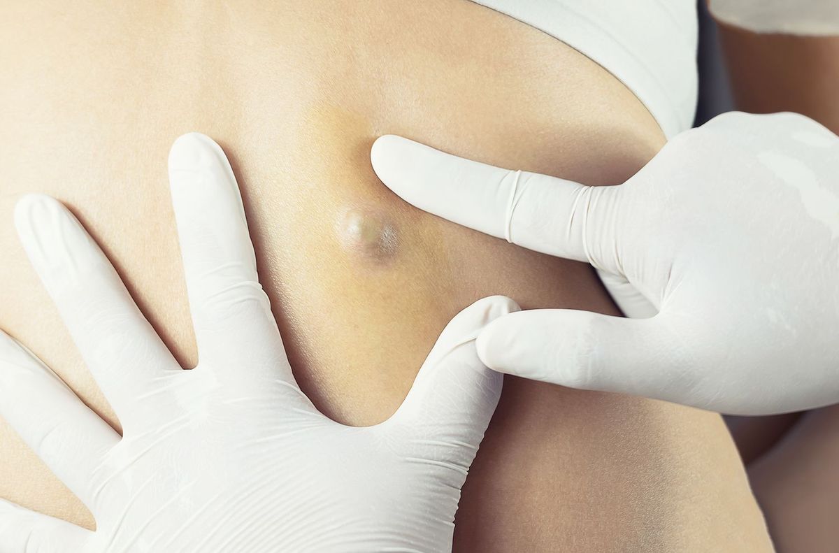 Fibroma xərçəngə çevrilə bilər?   - Onkoloqdan cavab