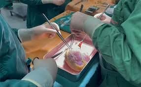 Transplantasiya edilən xəstə quduzluqdan öldü 