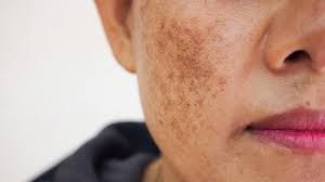 Kseroderma – Günəş təhlükəli və ölümcül olur 