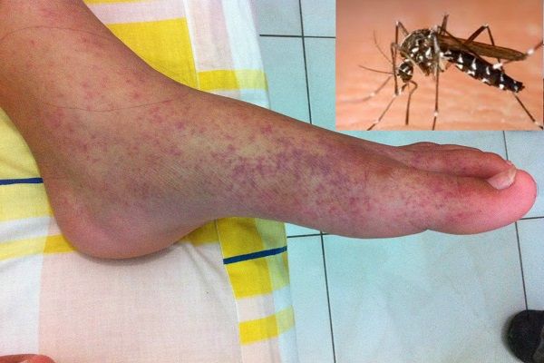 20 ilin ən güclü epidemiyası   - Çikunqunya qızdırması