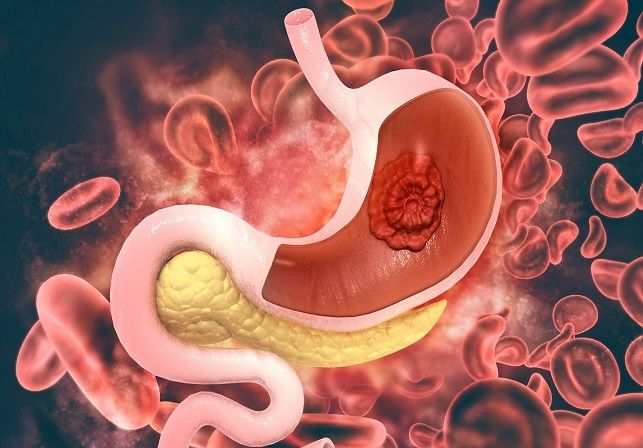 Bu vitamin çatışmayanda  – mədədə xərçəng yaranır