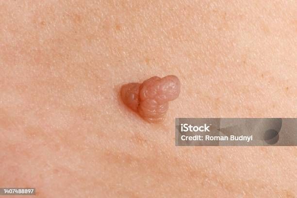 Kişi cinsiyyət üzvlərində papilloma  – Evli kişilərə xəbərdarlıq