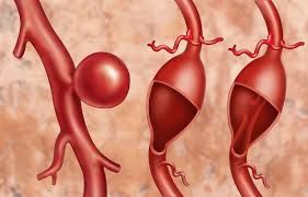 Hansı vitaminin əskikliyi damarları nazildir? 