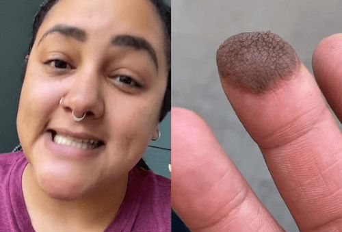 Dəri transplantasiyası olan qızın barmağından     tüklər çıxdı