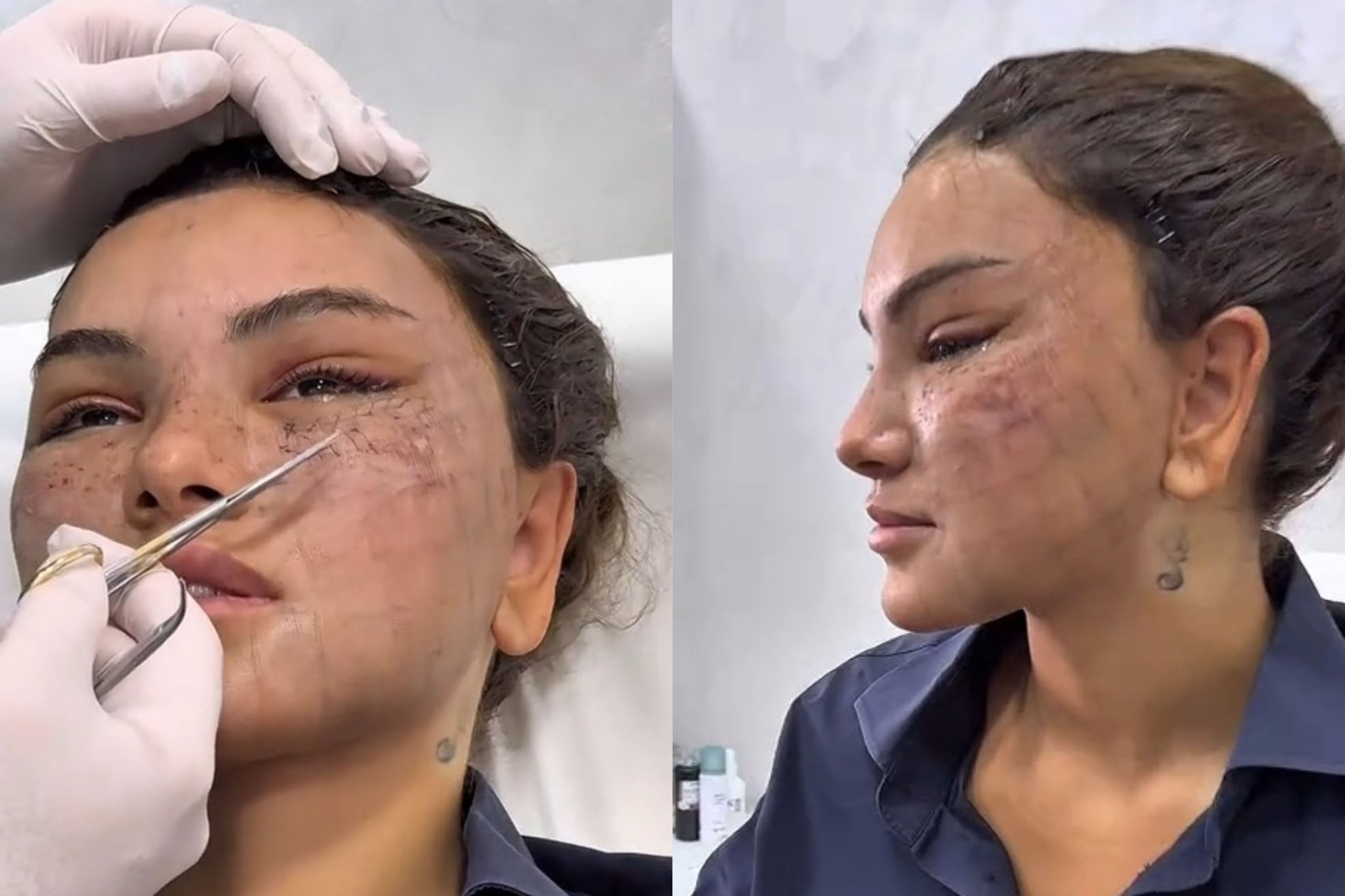 Estetik prosedurlardan sonra müğənninin üzü tanınmaz hala düşdü -  VİDEO