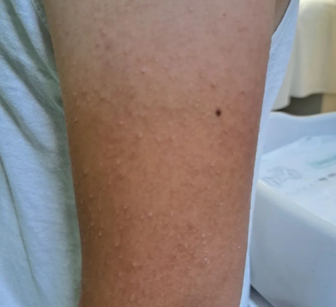Uşağın dərisində bu cür səpkilər varsa... -  Pediatrdan xəbərdarlıq