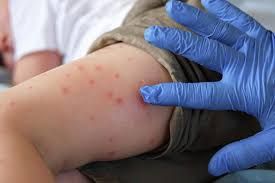 Çikunqaya infeksiyası Çindən ABŞ-a keçdi 