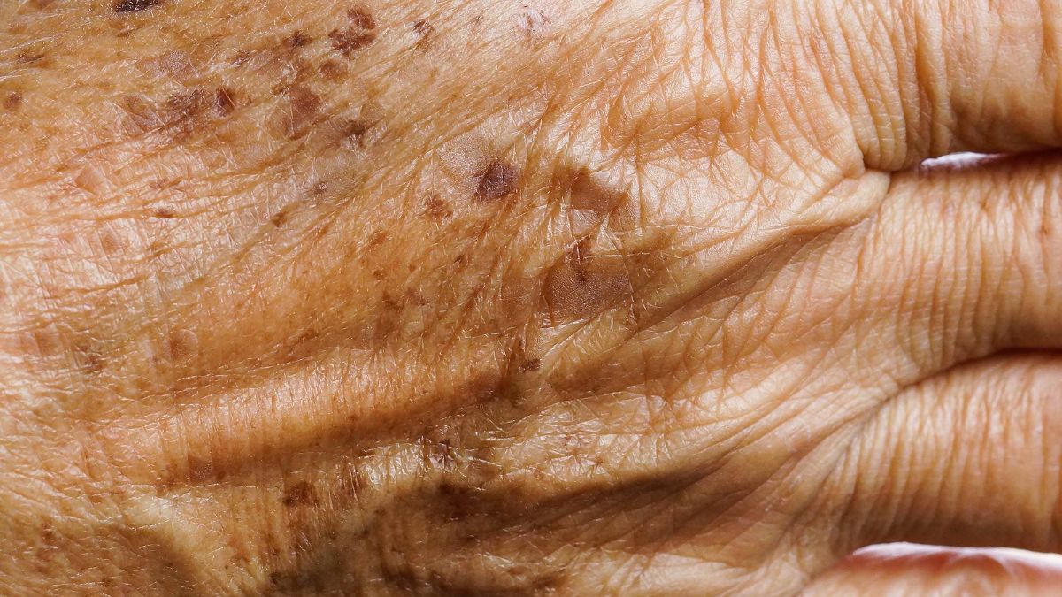 Gündə bir dəfə sürtün -  Qocalıq ləkələrini yox edir