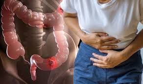 Bu cür qidalanma yoğun bağırsaq şişləri yaradır 