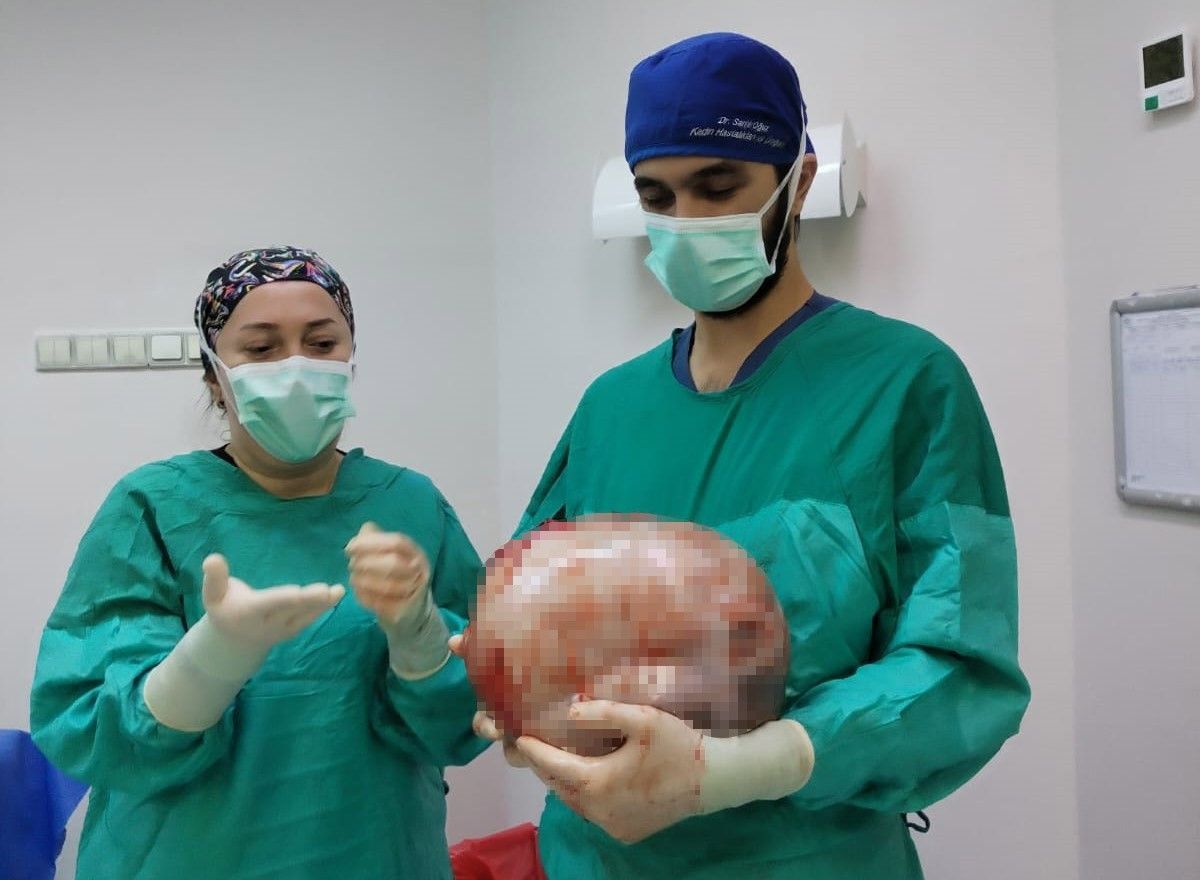 Qadının qarnından 9 kiloqramlıq şiş çıxarıldı -  FOTO