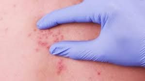 Bədəninizdə parazit olub-olmadığını evdə necə bilməli? 