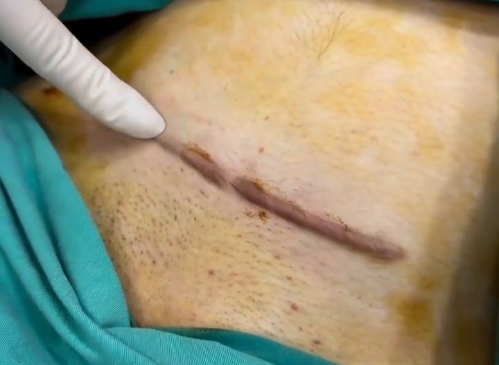 Kelleoid çapığı nədir? -  Həkimdən cavab