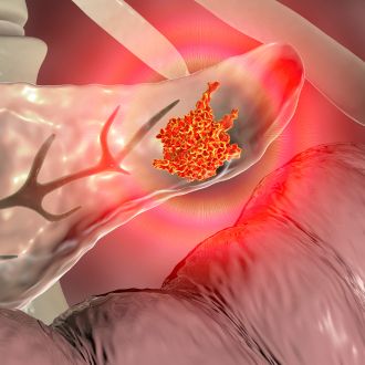 Mədəaltı vəz xərçəngi uzun qızdırma ilə başlaya bilər 