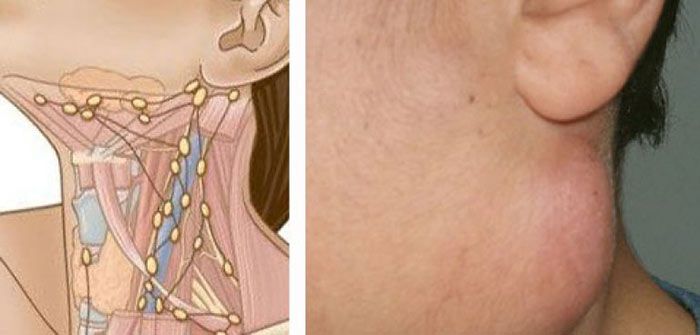 Boyunda şişmiş limfa düyünləri  –   Müalicəsi