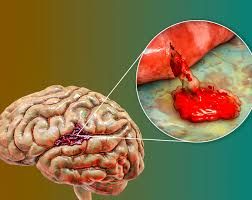 İnsultdan 1 həftə əvvəl hansı işarələr olur? 