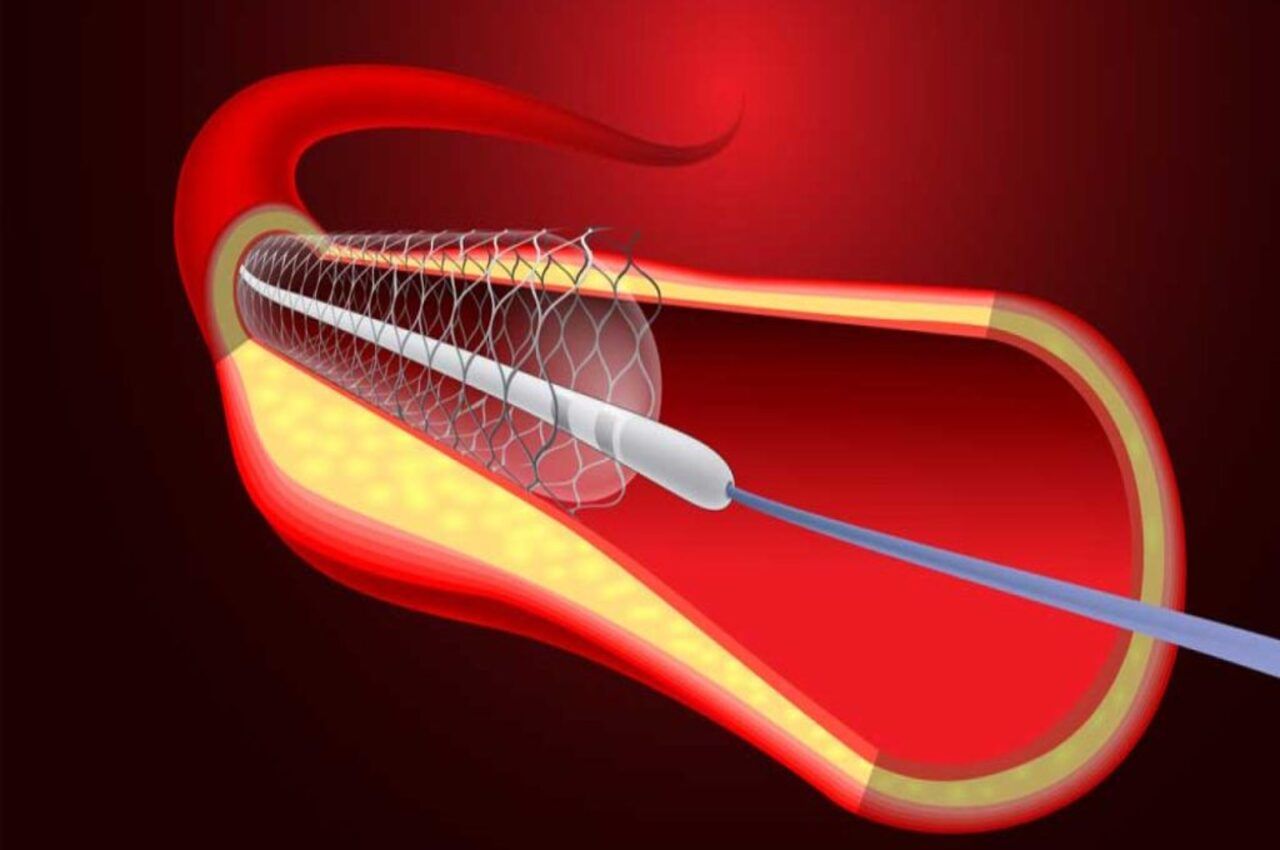 Stendlərin ömrü nə qədərdir? -  Kardioloqdan cavab
