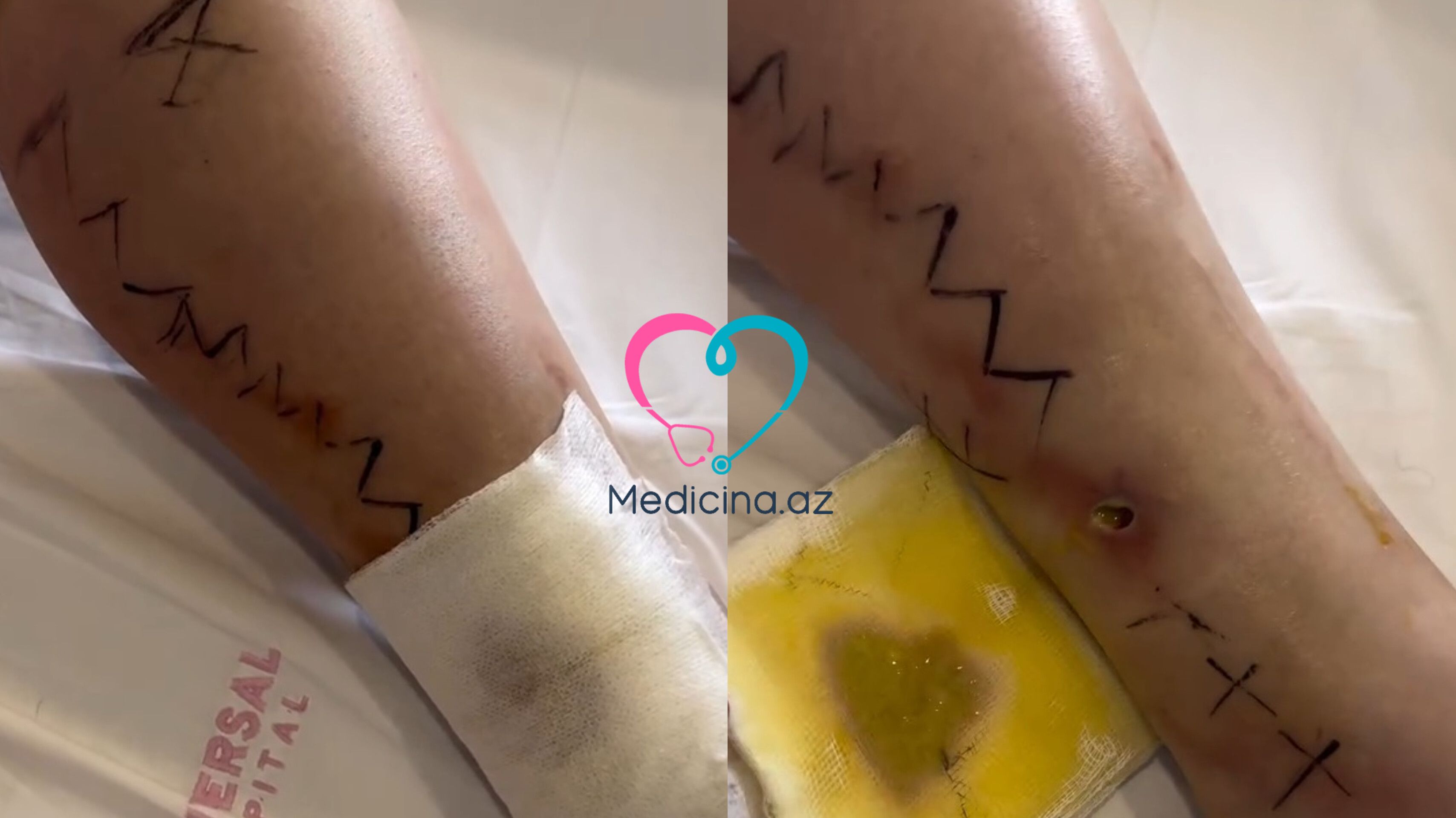 Daha bir qadın estetik prosedurun qurbanı oldu -  VİDEO
