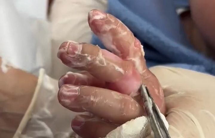 10 aylıq körpə yanıq xəsarəti aldı -  Əlini qaynar çaydana salıb... - VİDEO