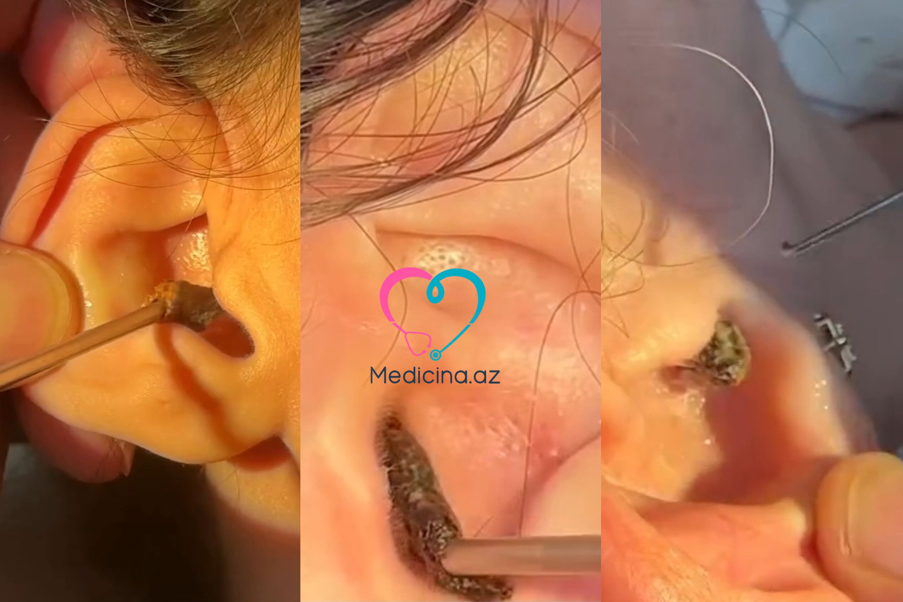 Qulağı pambıq çubuqlarla təmizləməyin nəticəsi -  Həkimdən xəbərdarlıq-VİDEO