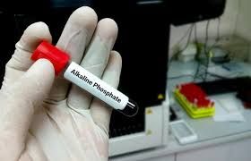 Ümumi qan analizi gizli sümük xəstəliyini göstərir 